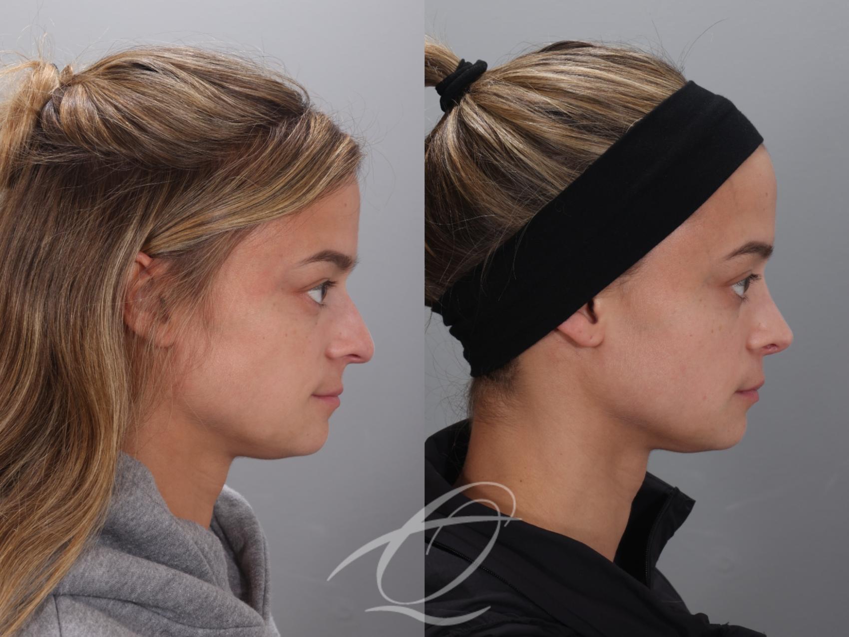 Rhinoplasty Case 1002023 Before & After Right Side | Serving Rochester, Syracuse & Buffalo, NY | Quatela Center for Plastic Surgery