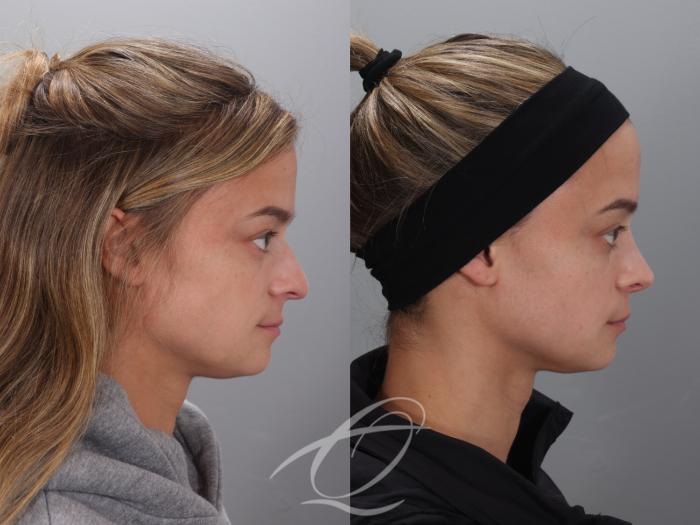 Rhinoplasty Case 1002023 Before & After Right Side | Serving Rochester, Syracuse & Buffalo, NY | Quatela Center for Plastic Surgery