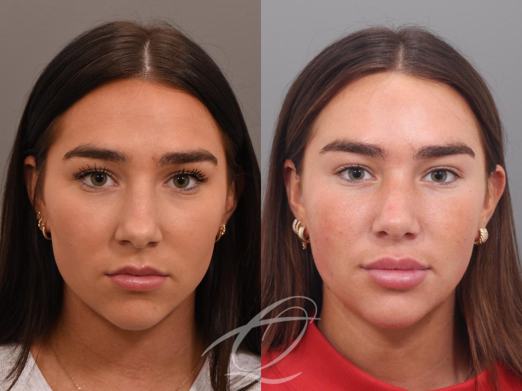 Rhinoplasty Case 1002026 Before & After Front | Serving Rochester, Syracuse & Buffalo, NY | Quatela Center for Plastic Surgery