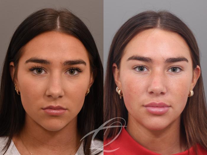 Rhinoplasty Case 1002026 Before & After Front | Serving Rochester, Syracuse & Buffalo, NY | Quatela Center for Plastic Surgery