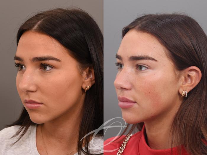 Rhinoplasty Case 1002026 Before & After Left Oblique | Serving Rochester, Syracuse & Buffalo, NY | Quatela Center for Plastic Surgery