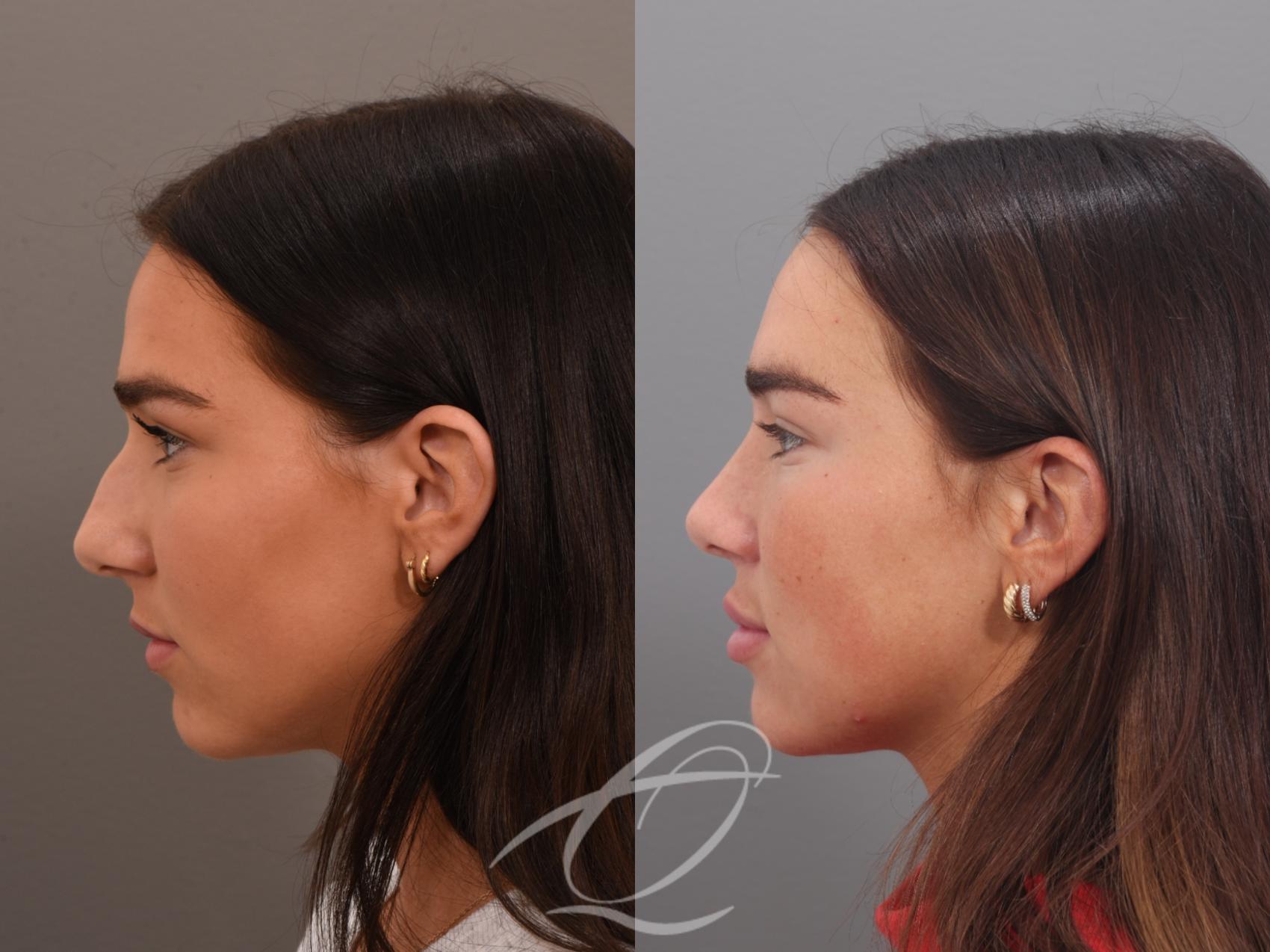 Rhinoplasty Case 1002026 Before & After Left Side | Serving Rochester, Syracuse & Buffalo, NY | Quatela Center for Plastic Surgery