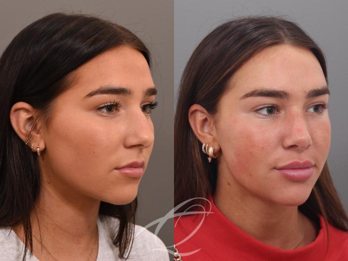 Rhinoplasty Case 1002026 Before & After Right Oblique | Serving Rochester, Syracuse & Buffalo, NY | Quatela Center for Plastic Surgery