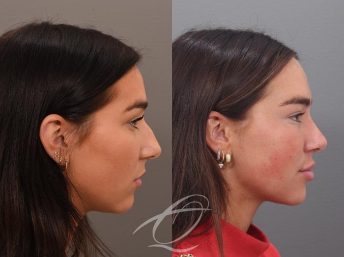 Rhinoplasty Case 1002026 Before & After Right Side | Serving Rochester, Syracuse & Buffalo, NY | Quatela Center for Plastic Surgery