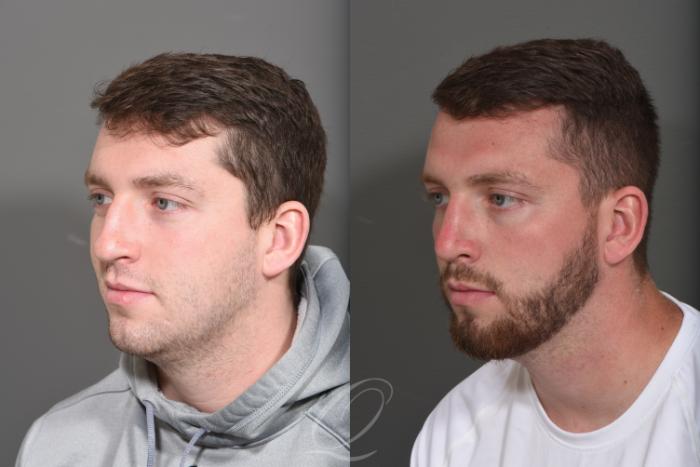 Rhinoplasty Case 1372 Before & After Left Oblique | Serving Rochester, Syracuse & Buffalo, NY | Quatela Center for Plastic Surgery
