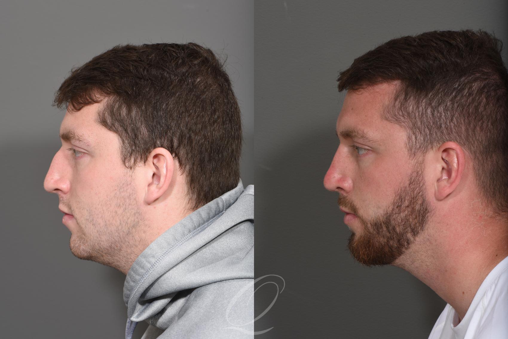 Rhinoplasty Case 1372 Before & After Left Side | Serving Rochester, Syracuse & Buffalo, NY | Quatela Center for Plastic Surgery