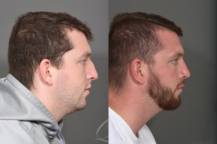 Rhinoplasty Case 1372 Before & After Right Side | Serving Rochester, Syracuse & Buffalo, NY | Quatela Center for Plastic Surgery