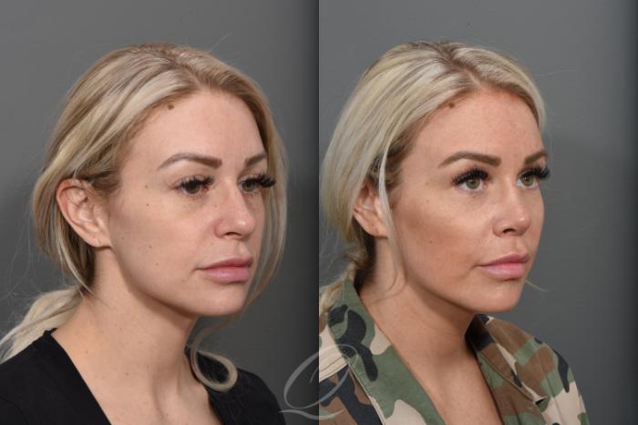 Rhinoplasty Case 1374 Before & After Right Oblique | Serving Rochester, Syracuse & Buffalo, NY | Quatela Center for Plastic Surgery