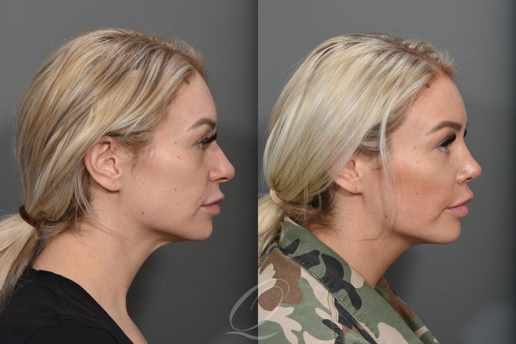 Rhinoplasty Case 1374 Before & After Right Side | Serving Rochester, Syracuse & Buffalo, NY | Quatela Center for Plastic Surgery