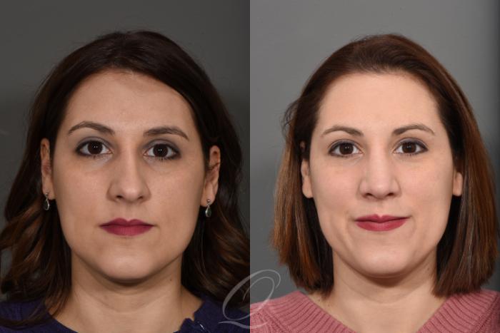 Rhinoplasty Case 1377 Before & After Front | Serving Rochester, Syracuse & Buffalo, NY | Quatela Center for Plastic Surgery
