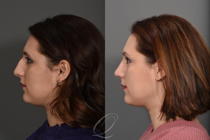 Rhinoplasty Case 1377 Before & After Left Side | Serving Rochester, Syracuse & Buffalo, NY | Quatela Center for Plastic Surgery