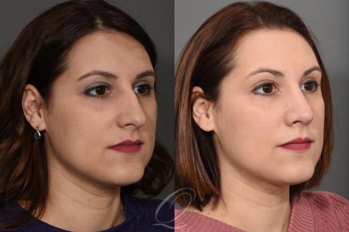 Rhinoplasty Case 1377 Before & After Right Oblique | Serving Rochester, Syracuse & Buffalo, NY | Quatela Center for Plastic Surgery