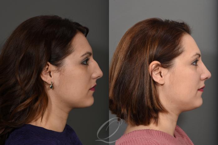 Rhinoplasty Case 1377 Before & After Right Side | Serving Rochester, Syracuse & Buffalo, NY | Quatela Center for Plastic Surgery