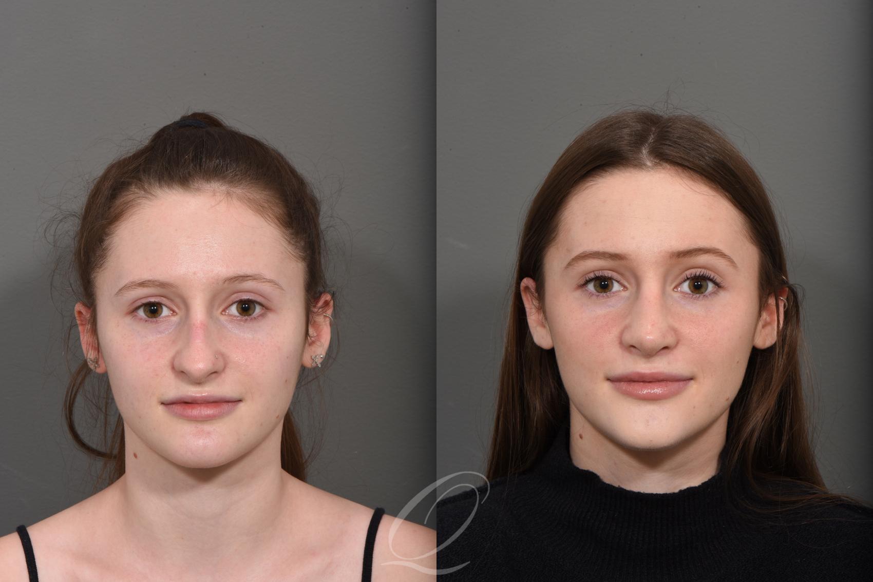 Rhinoplasty Case 1378 Before & After Front | Serving Rochester, Syracuse & Buffalo, NY | Quatela Center for Plastic Surgery
