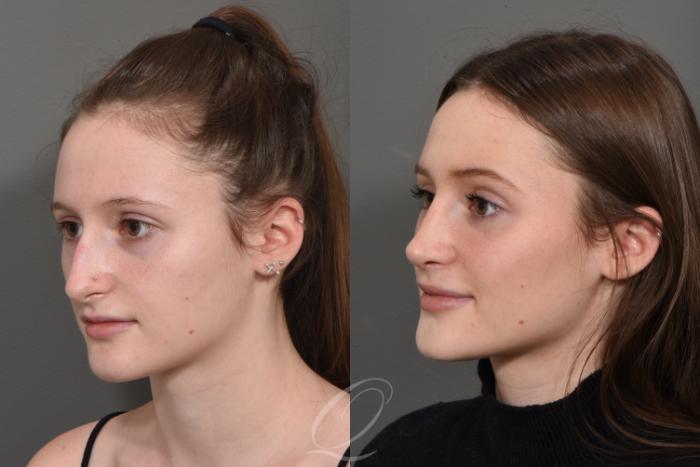 Rhinoplasty Case 1378 Before & After Left Oblique | Serving Rochester, Syracuse & Buffalo, NY | Quatela Center for Plastic Surgery