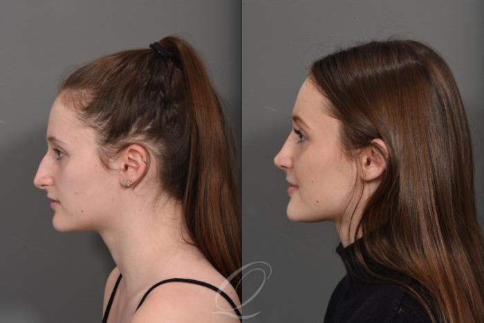Rhinoplasty Case 1378 Before & After Left Side | Serving Rochester, Syracuse & Buffalo, NY | Quatela Center for Plastic Surgery