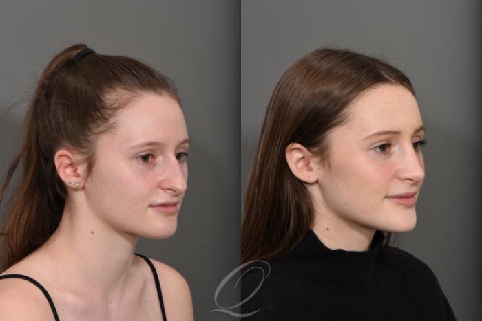 Rhinoplasty Case 1378 Before & After Right Oblique | Serving Rochester, Syracuse & Buffalo, NY | Quatela Center for Plastic Surgery