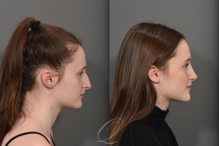 Rhinoplasty Case 1378 Before & After Right Side | Serving Rochester, Syracuse & Buffalo, NY | Quatela Center for Plastic Surgery