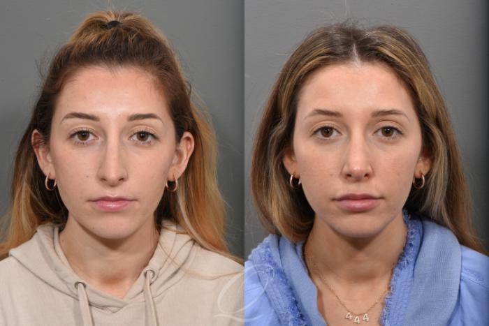 Rhinoplasty Case 1492 Before & After Front | Serving Rochester, Syracuse & Buffalo, NY | Quatela Center for Plastic Surgery