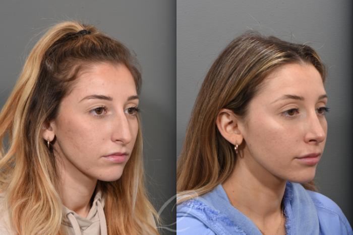 Rhinoplasty Case 1492 Before & After Right Oblique | Serving Rochester, Syracuse & Buffalo, NY | Quatela Center for Plastic Surgery