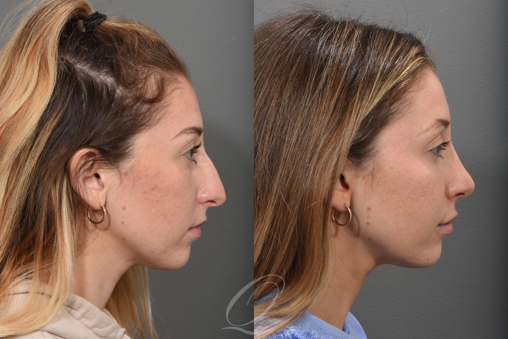 Rhinoplasty Case 1492 Before & After Right Side | Serving Rochester, Syracuse & Buffalo, NY | Quatela Center for Plastic Surgery