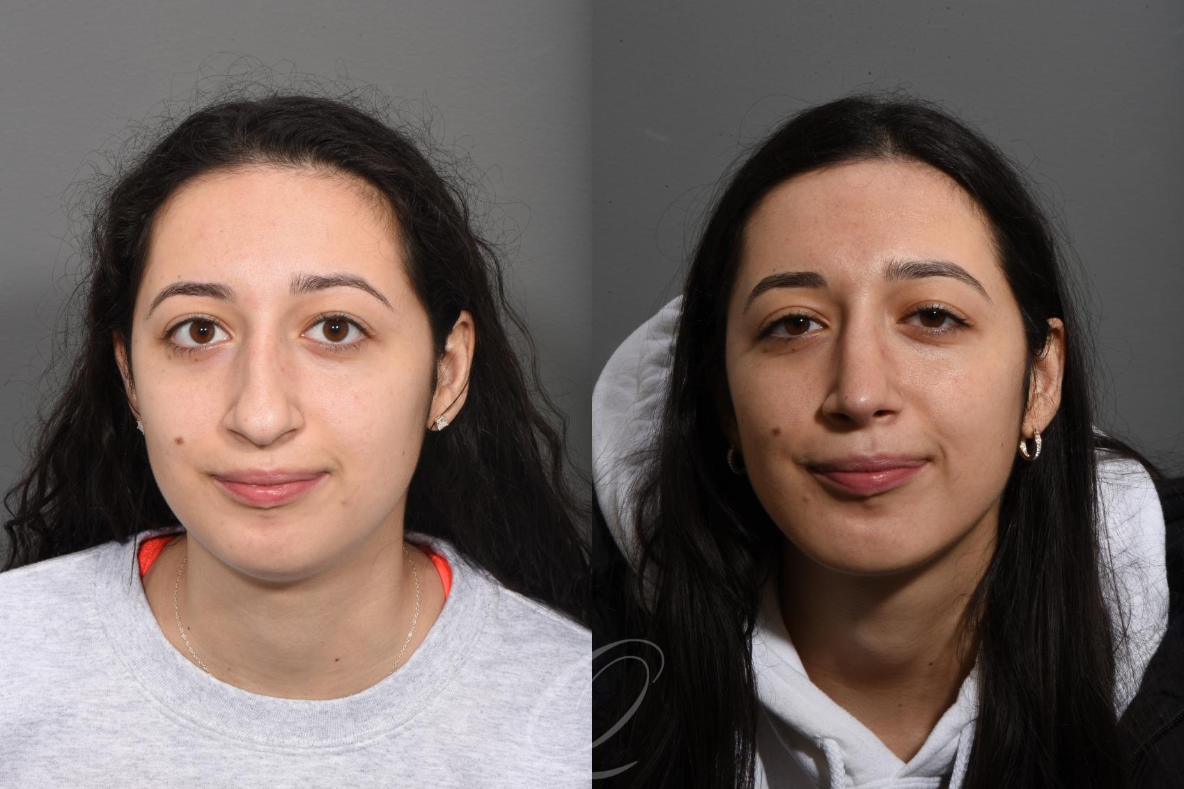 Rhinoplasty Case 1493 Before & After Front | Serving Rochester, Syracuse & Buffalo, NY | Quatela Center for Plastic Surgery