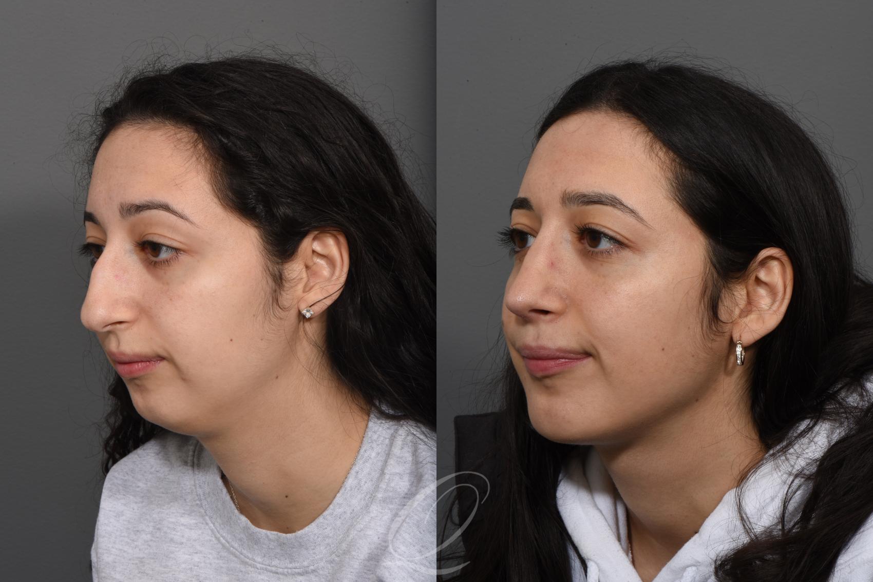 Rhinoplasty Case 1493 Before & After Left Oblique | Serving Rochester, Syracuse & Buffalo, NY | Quatela Center for Plastic Surgery