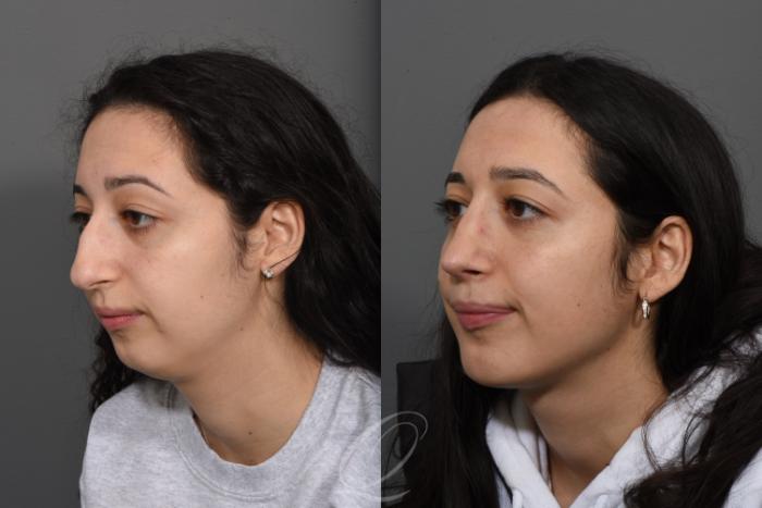 Chin Augmentation Case 1493 Before & After Left Oblique | Serving Rochester, Syracuse & Buffalo, NY | Quatela Center for Plastic Surgery