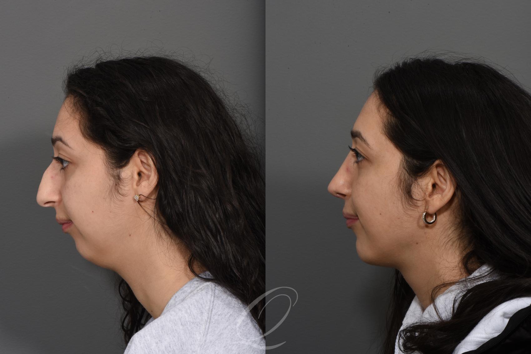 Deep Neck Contouring Case 1493 Before & After Left Side | Serving Rochester, Syracuse & Buffalo, NY | Quatela Center for Plastic Surgery