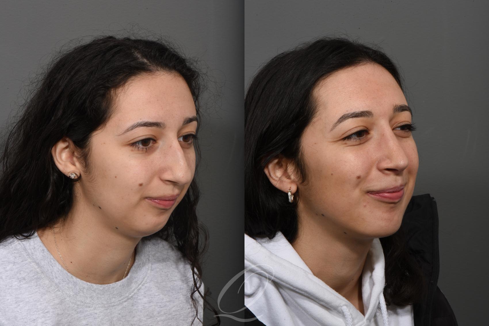Rhinoplasty Case 1493 Before & After Right Oblique | Serving Rochester, Syracuse & Buffalo, NY | Quatela Center for Plastic Surgery