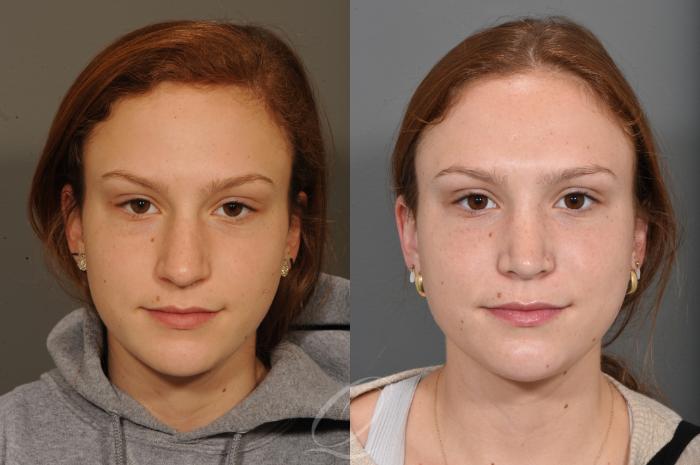 Rhinoplasty Case 1497 Before & After Front | Serving Rochester, Syracuse & Buffalo, NY | Quatela Center for Plastic Surgery