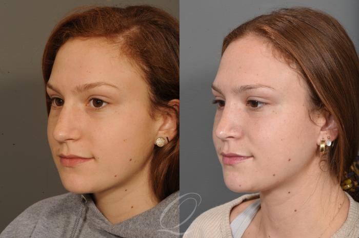 Rhinoplasty Case 1497 Before & After Left Oblique | Serving Rochester, Syracuse & Buffalo, NY | Quatela Center for Plastic Surgery