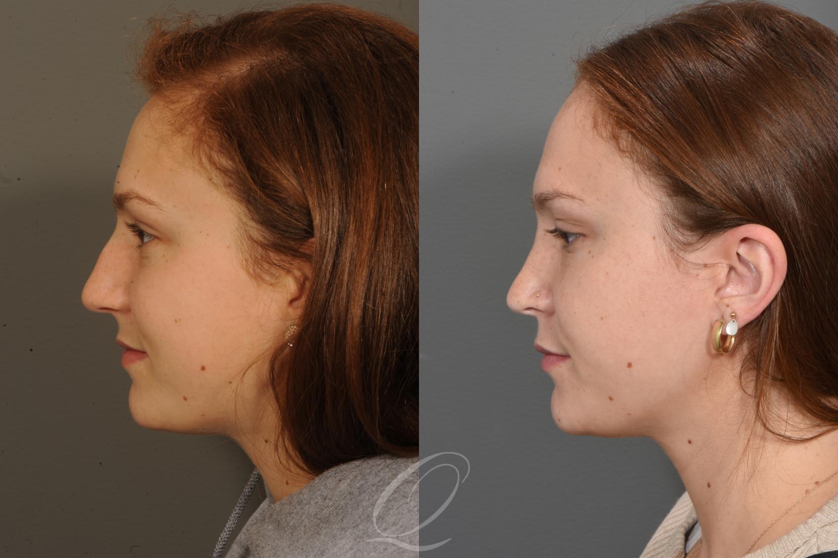 Rhinoplasty Case 1497 Before & After Left Side | Serving Rochester, Syracuse & Buffalo, NY | Quatela Center for Plastic Surgery