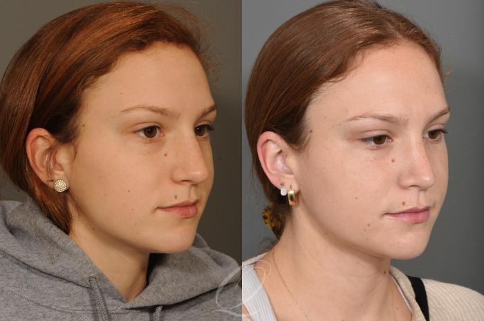 Rhinoplasty Case 1497 Before & After Right Oblique | Serving Rochester, Syracuse & Buffalo, NY | Quatela Center for Plastic Surgery