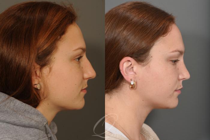 Rhinoplasty Case 1497 Before & After Right Side | Serving Rochester, Syracuse & Buffalo, NY | Quatela Center for Plastic Surgery