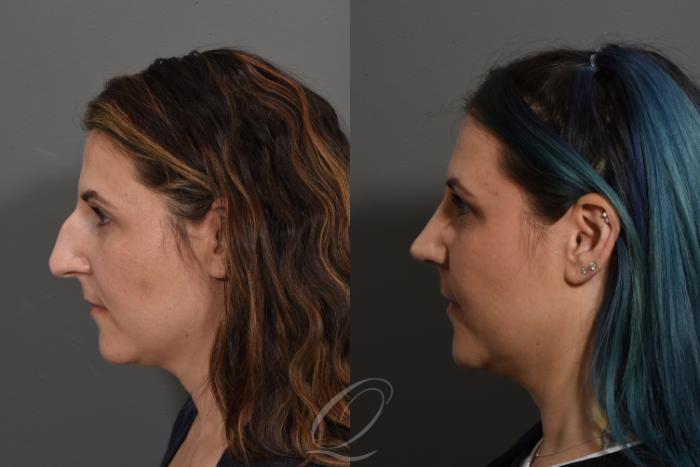 Rhinoplasty Case 1498 Before & After Left Side | Serving Rochester, Syracuse & Buffalo, NY | Quatela Center for Plastic Surgery