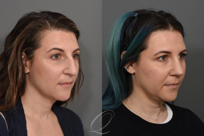 Rhinoplasty Case 1498 Before & After Right Oblique | Serving Rochester, Syracuse & Buffalo, NY | Quatela Center for Plastic Surgery
