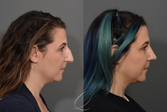 Rhinoplasty Case 1498 Before & After Right Side | Serving Rochester, Syracuse & Buffalo, NY | Quatela Center for Plastic Surgery