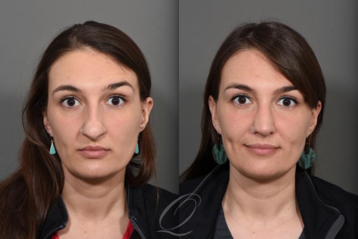 Rhinoplasty Case 1499 Before & After Front | Serving Rochester, Syracuse & Buffalo, NY | Quatela Center for Plastic Surgery