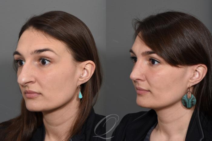 Rhinoplasty Case 1499 Before & After Left Oblique | Serving Rochester, Syracuse & Buffalo, NY | Quatela Center for Plastic Surgery