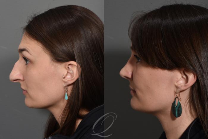Rhinoplasty Case 1499 Before & After Left Side | Serving Rochester, Syracuse & Buffalo, NY | Quatela Center for Plastic Surgery