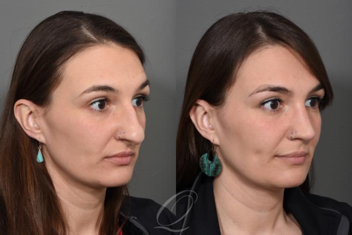 Rhinoplasty Case 1499 Before & After Right Oblique | Serving Rochester, Syracuse & Buffalo, NY | Quatela Center for Plastic Surgery