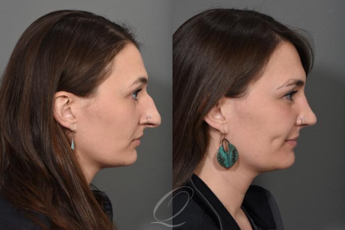 Rhinoplasty Case 1499 Before & After Right Side | Serving Rochester, Syracuse & Buffalo, NY | Quatela Center for Plastic Surgery