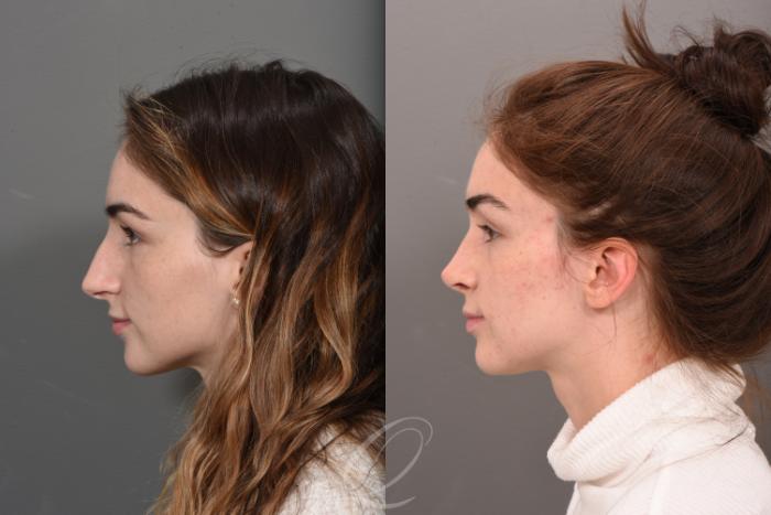 Rhinoplasty Case 1500 Before & After Left Side | Serving Rochester, Syracuse & Buffalo, NY | Quatela Center for Plastic Surgery