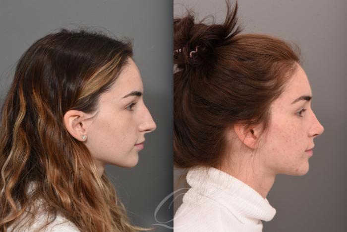 Rhinoplasty Case 1500 Before & After Right Side | Serving Rochester, Syracuse & Buffalo, NY | Quatela Center for Plastic Surgery