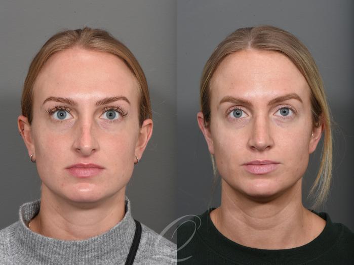 Rhinoplasty Case 1502 Before & After Front | Serving Rochester, Syracuse & Buffalo, NY | Quatela Center for Plastic Surgery