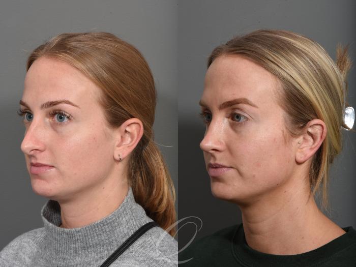 Rhinoplasty Case 1502 Before & After Left Oblique | Serving Rochester, Syracuse & Buffalo, NY | Quatela Center for Plastic Surgery