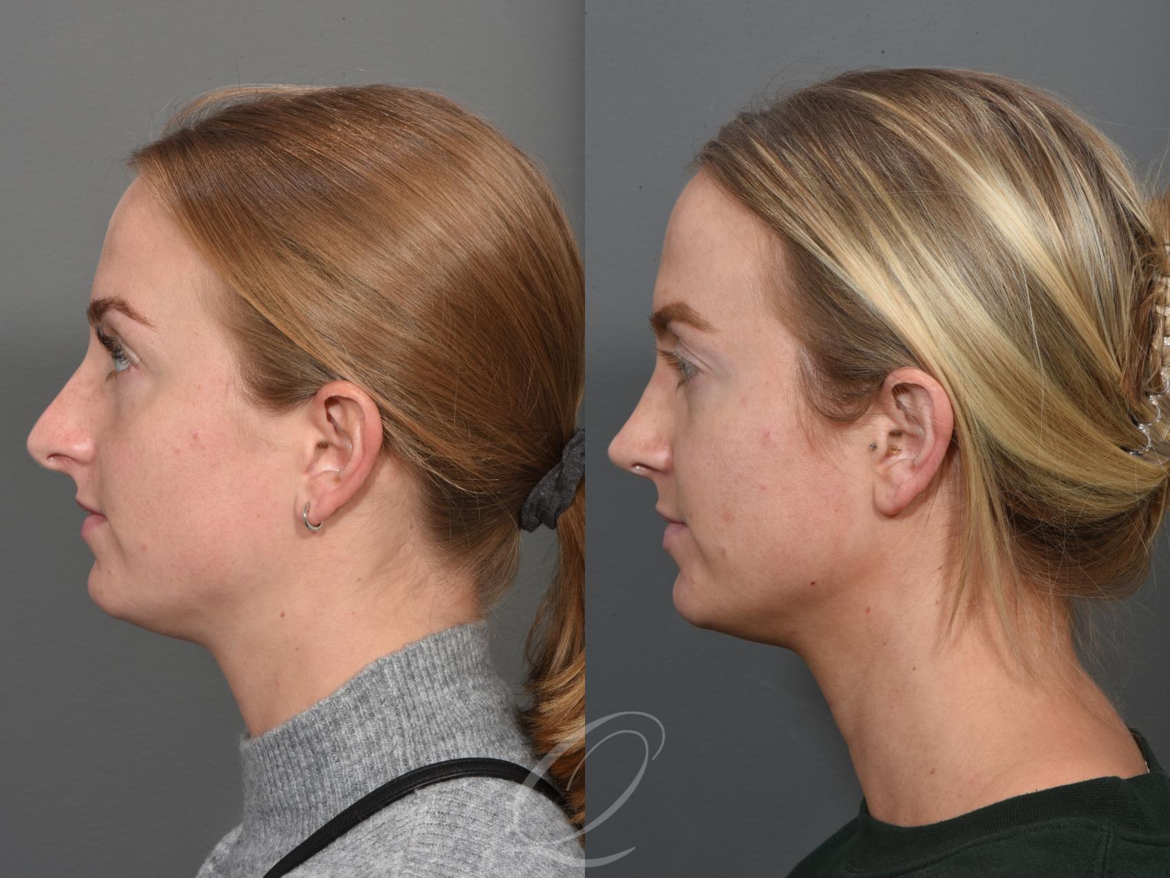 Rhinoplasty Case 1502 Before & After Left Side | Serving Rochester, Syracuse & Buffalo, NY | Quatela Center for Plastic Surgery