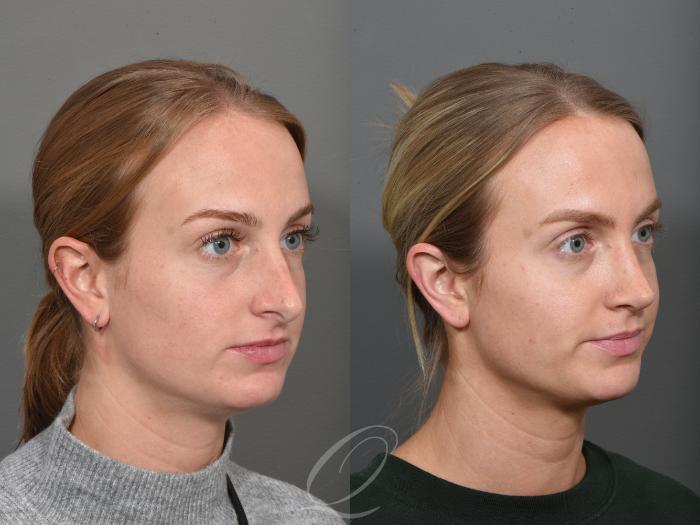 Rhinoplasty Case 1502 Before & After Right Oblique | Serving Rochester, Syracuse & Buffalo, NY | Quatela Center for Plastic Surgery