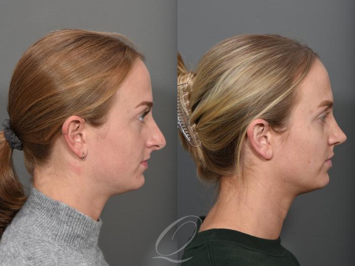 Rhinoplasty Case 1502 Before & After Right Side | Serving Rochester, Syracuse & Buffalo, NY | Quatela Center for Plastic Surgery